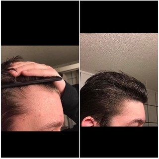 Minoxidil - Dung dịch hỗ trợ mọc tóc cho nam