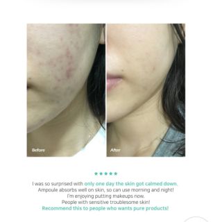 Dòng sản phẩm da mụn Byecom Pure Calming
