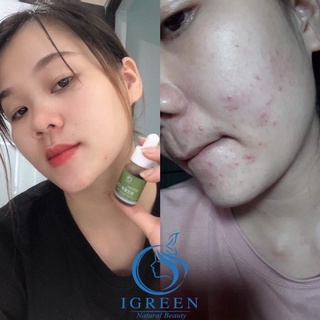 SERUM DIẾP CÁ