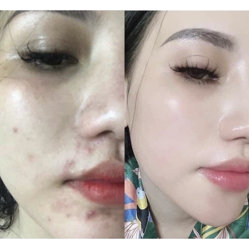 Serum mụn IIMONO sản phẩm chăm sóc da 6ml | BigBuy360 - bigbuy360.vn