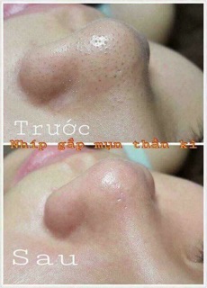 Nhíp gắp mụn Thần thánh Vacosi