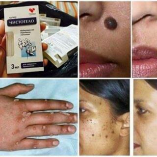 GELDVELINIL CỦA NGA trị nốt ruồi an toàn tại nhà