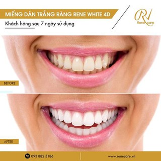 Miếng Dán Trắng Răng Rene White 4D