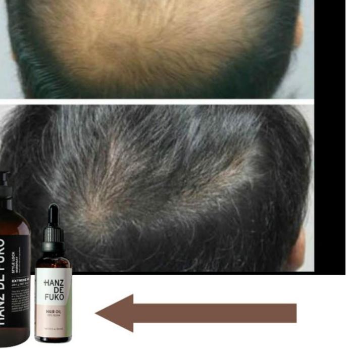 (Hàng Mới Về) Serum Kích Thích Mọc Tóc Hanz De Fuko Baldness