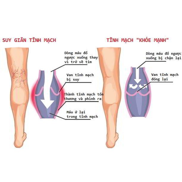 Kem Trị Suy Giãn Tĩnh Mạch VArIKOSETTE