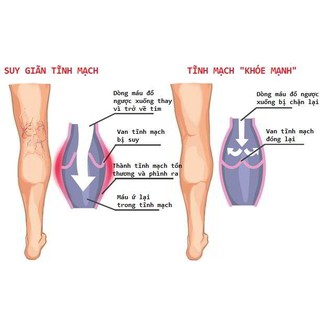 Kem varikosette trị suy giãn tĩnh mạch