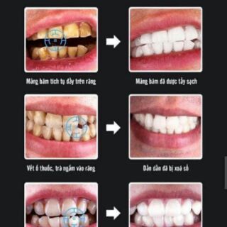 trắng răng than hoạt tính