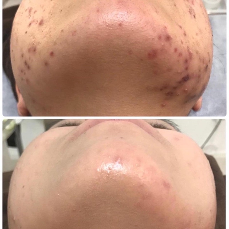 VIÊN UỐNG BIOTRADE ACNE OUT HỖ TRỢ NGỪA MỤN