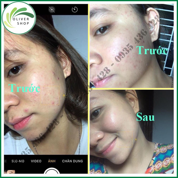 ⚡COMBO 2 HỘP⚡ Khử Mụn Sạch Thâm - Kem Thảo Dược Hoa Đào - Chiết Xuất Từ Thiên Nhiên - Chính Hãng 100%