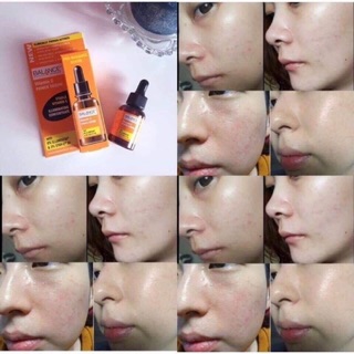 Serum Blance Vitamin C