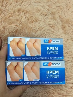 KEM TRỊ NỨT GÓT CHÂN NGA