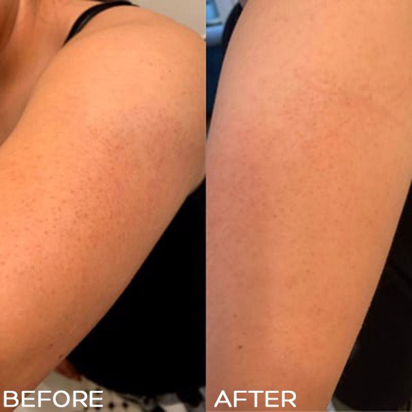 Kem dưỡng thể giảm viêm nang lông PLC 2% BHA | BigBuy360 - bigbuy360.vn