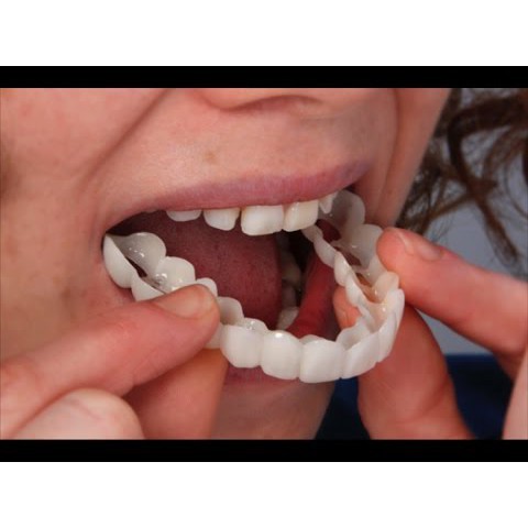 [HOT] Dụng cụ niềng răng tại nhà snapon smile