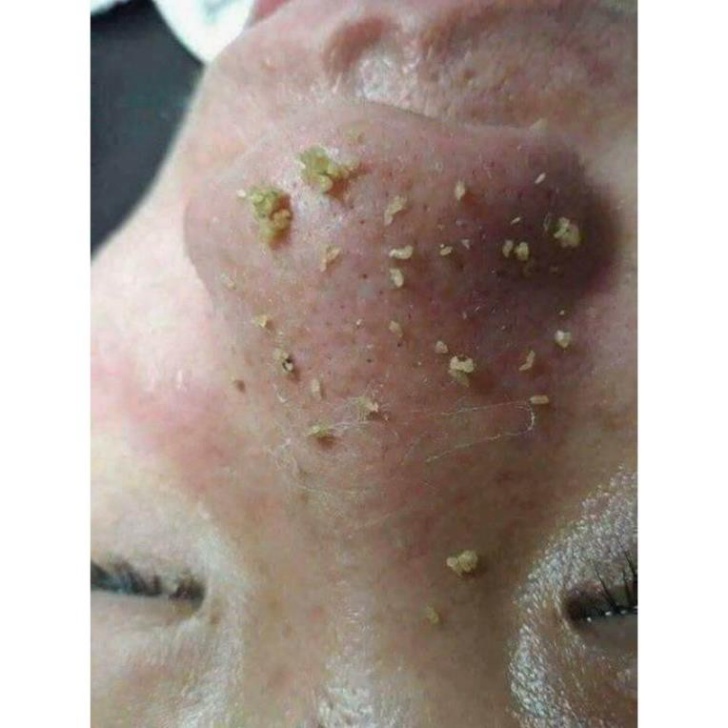 bộ 4 cây nặn mụn 8 đầu kèm hộp cao cấp chuyên nghiệp