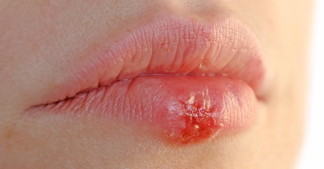 MIẾNG DÁN ĐIỀU TRỊ MỤN RỘP (HERPES) MÔI | BigBuy360 - bigbuy360.vn