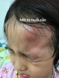 DẦU ĐUỔI MUỖI KIM