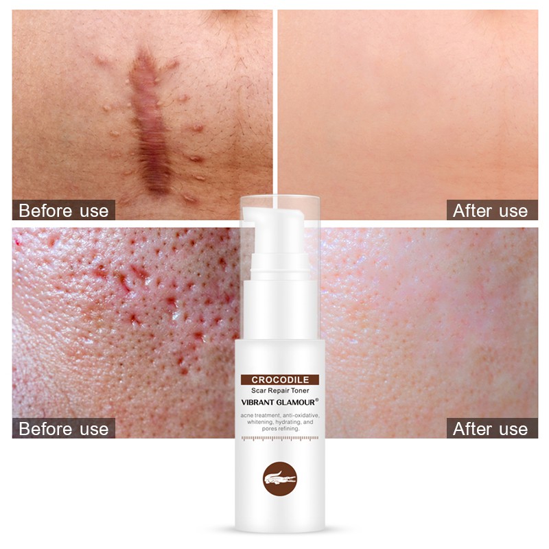 Toner VIBRANT GLAMOUR hỗ trợ giảm sẹo do mụn giảm vết rạn da cấp ẩm không gây nhờn dính phù hợp với mọi loại da 40ml | BigBuy360 - bigbuy360.vn