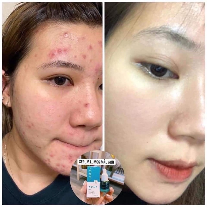 [Chính hãng]Serum mụn Lumos Acne mẫu mới