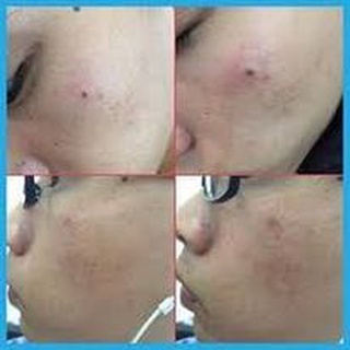 Kem xóa ruồi ,  mụn thịt , tàn nhang