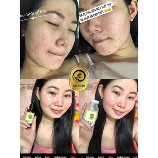 [ Có Thể Lựa Chọn 1 IN 2] Combo Dưởng Hoàng Thiên Sâm