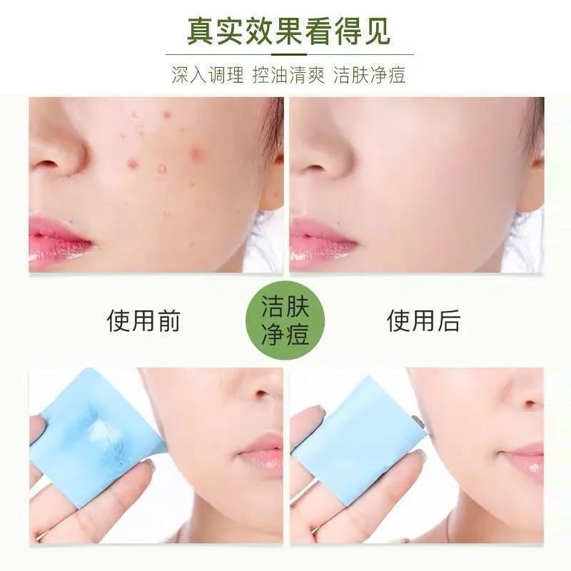 ❣♗Miếng lót Cotton axit Salicylic loại bỏ mụn đầu đen hiệu quả | BigBuy360 - bigbuy360.vn