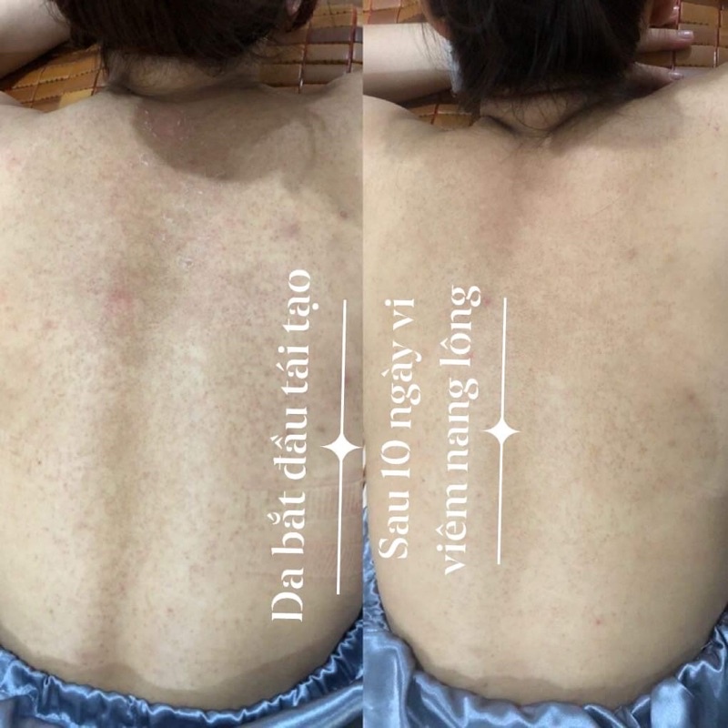 VI THẢO DƯỢC tái tạo sau 3-5 ngày loại bỏ Mụn, Nám, lỗ chân lông to