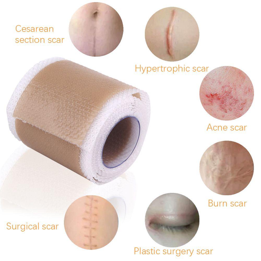 Miếng Dán Hỗ Trợ Giảm Sẹo Mụn An Toàn Hiệu Quả