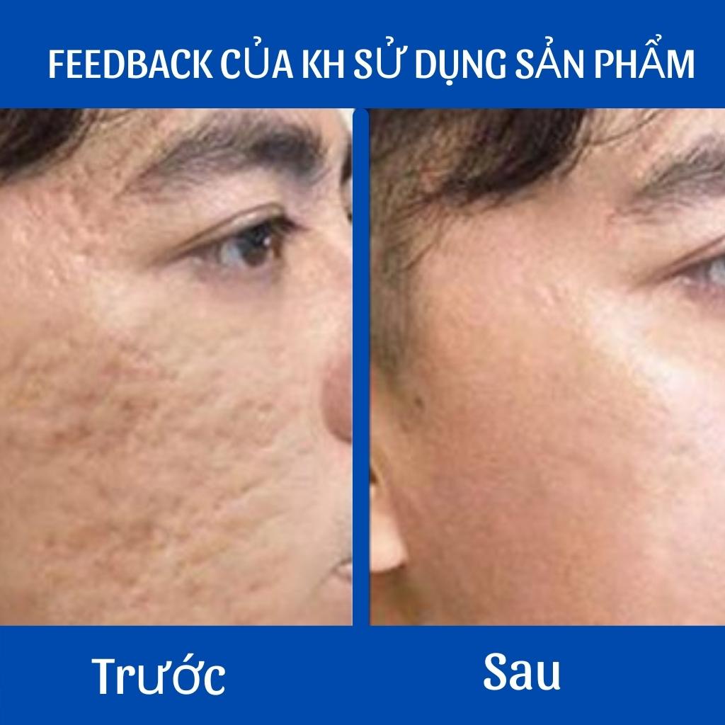 Tinh chất giảm sẹo lâu năm-FREESHIP-Inviscar Streatment 15ml-Hiệu quả nhanh,Không gây kích ứng.