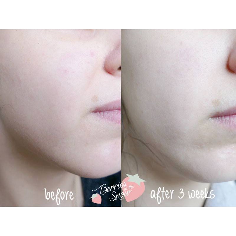 Kem Pair Acne Hỗ Trợ Làm Giảm Và Loại Bỏ Mụn Nhật Bản