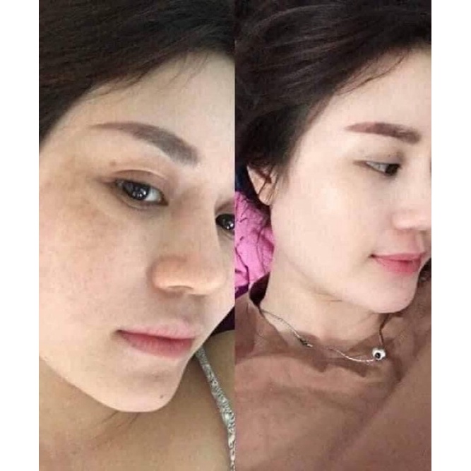 Kem dưỡng trắng da ban đêm giảm được nám , tàn nhang Qnic care