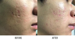 Fusion F-Matrix Tinh Chất Làm Đầy Sẹo Rổ (Cam Kết Chính Hãng)