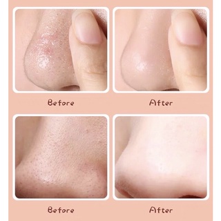 MIẾNG DÁN ĐẨY MỤN ĐẦU ĐEN CIRACLE GOODBYE BLACKHEAD
