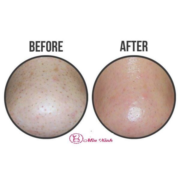 BÔNG NẶN MỤN ĐẦU ĐEN [CIRACLE] Good Bye Blackhead (hộp 20 miếng)