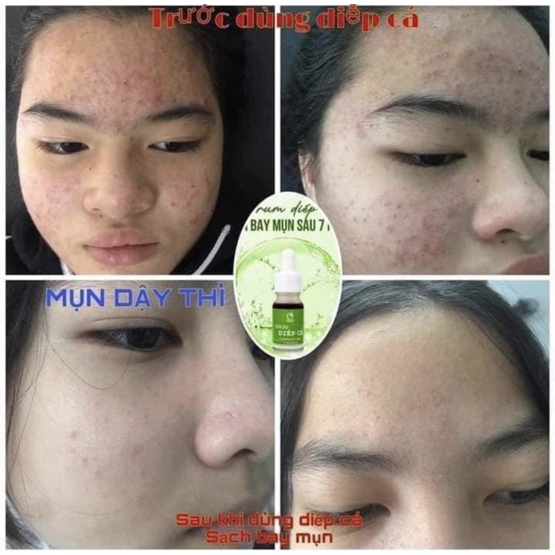 [MẪU MỚI 2024] SERUM MỤN DIẾP CÁ IGREEN – THIÊN NHIÊN - GIẢM MỤN, GIẢM THÂM, CĂNG BÓNG, SÁNG MỊN, SE KHÍT LỖ CHÂN LÔNG