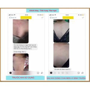 MEN VI SINH TAVIDA HẾT MỤN LƯNG, VIÊM NANG LÔNG, MẨN NGỨA | BigBuy360 - bigbuy360.vn