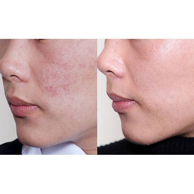 Gel Chấm Mụn Giảm Viêm , Ngừa Mụn Tái Tạo Da DERMACOS FARMONA 15ml | BigBuy360 - bigbuy360.vn