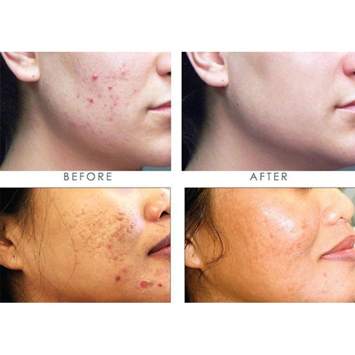 Kem Giảm Mụn DERMATON US 20gr, Giảm Mụn Trứng Cá, Mụn Cám, Mụn Đầu Đen Giảm Mụn Sưng