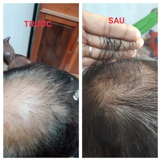 Serum amla dưỡng tóc-kích mọc tóc