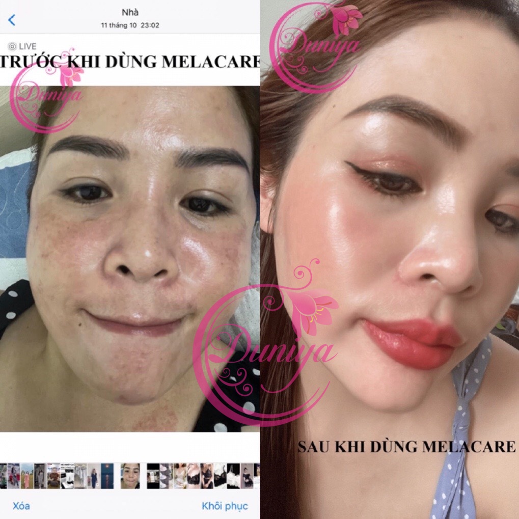 Kem Melacare Ấn Độ giảm nám mờ thâm, tàn nhang, trắng da 25g - duniya