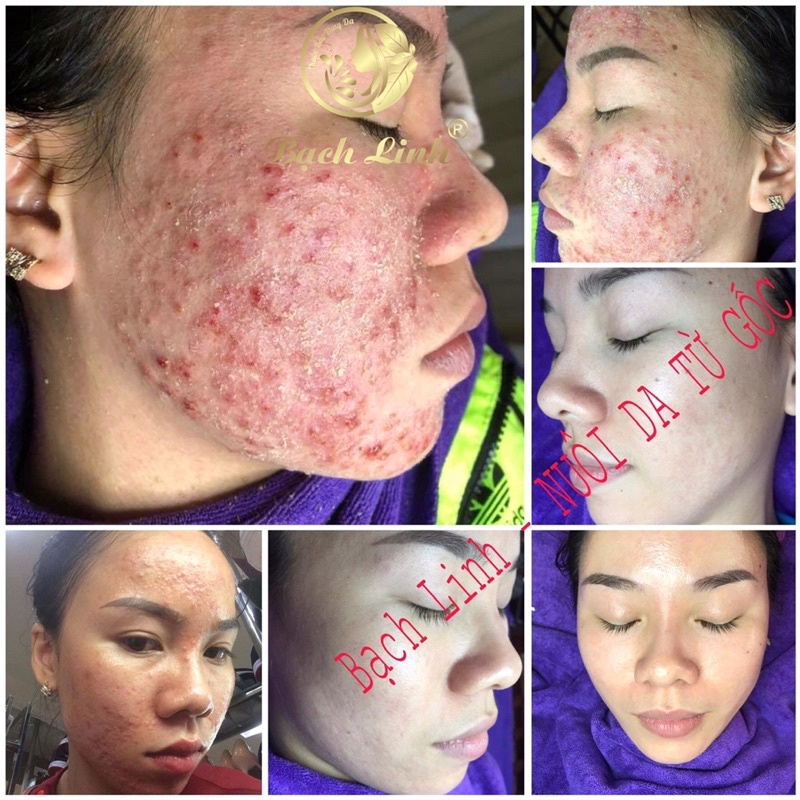 Bạch linh 02-bách y sâm 02 chuyên mụn (mẫu mới 30ml) | BigBuy360 - bigbuy360.vn