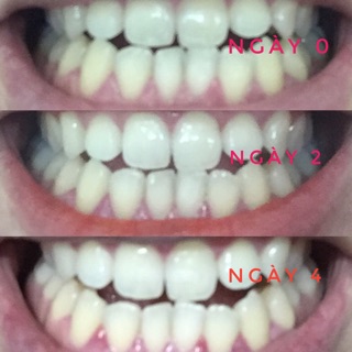 Smilee - Tự làm trắng răng an toàn