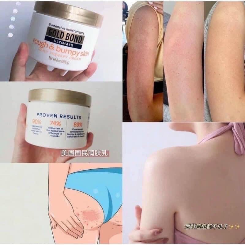 Kem dưỡng Body Gold Bond Rough and Bumpy Skin 226gr | BigBuy360 - bigbuy360.vn