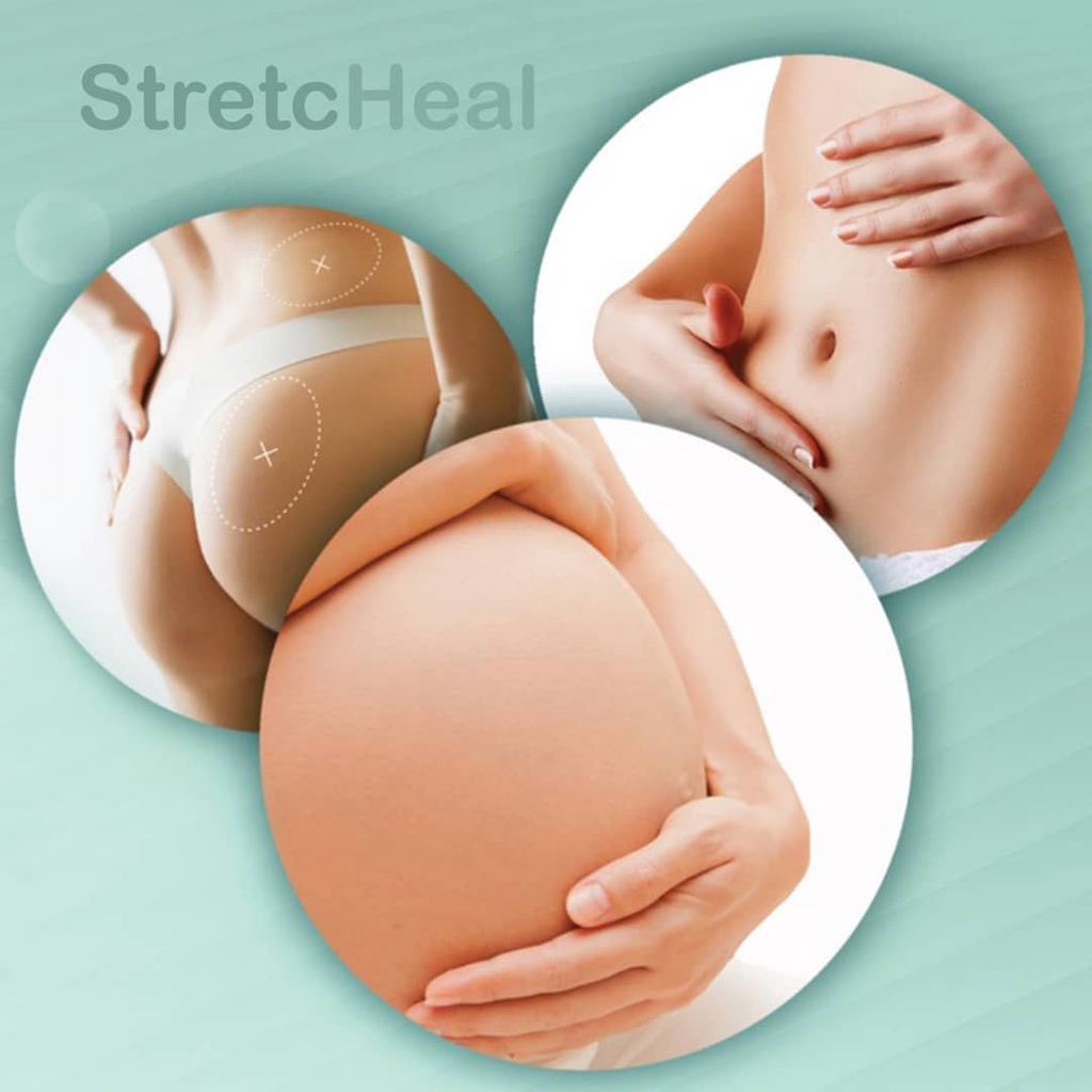 Kem bôi rạn STRETCHEAL mờ vết rạn sau sinh hiệu quả 180ml chính hãng Mỹ | BigBuy360 - bigbuy360.vn