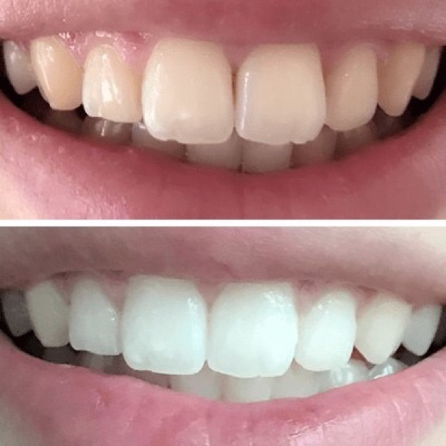Gel tẩy trắng răng Nite White nitewhite 22% Zoom (01 ống)