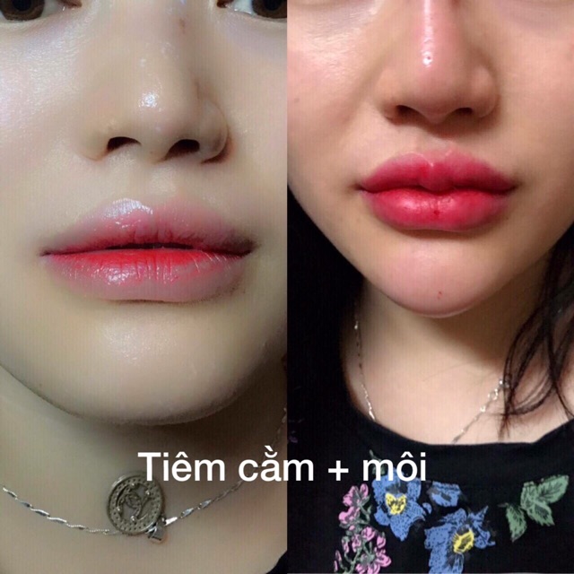 TIÊM FILLER MÔI TRÁI TIM , TẠO HÌNH CẰM VLINE,  LÀM ĐẦY RÃNH MÁ BABY, THÁI DƯƠNG