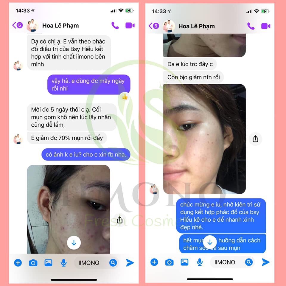 Giảm thâm mụn, bộ sản phẩm giảm mụn tinh chất thiên nhiên IIMONO | BigBuy360 - bigbuy360.vn