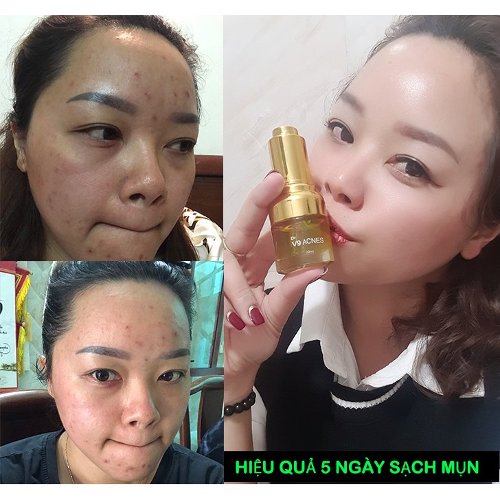 Serum Xóa Mụn, Dưỡng Trắng Da, Mờ Thâm Nám V9QUEEN