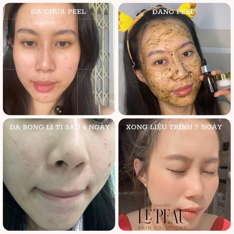 Peel mờ Thâm Mụn, Nám, Tàn Nhang, Sáng da - Tặng Serum B5 phục hồi da -  Peel da Vi Tảo Retinol - LE’PEAU