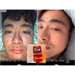 <Chính hãng> Cao Sâm Mụn 36 vị