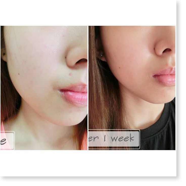 [Mã giảm giá sỉ mỹ phẩm chính hãng] Gel Làm Mờ Sẹo Và Thâm Mụn Hiruscar Post Acne 5g